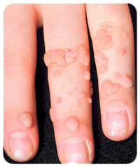 warts